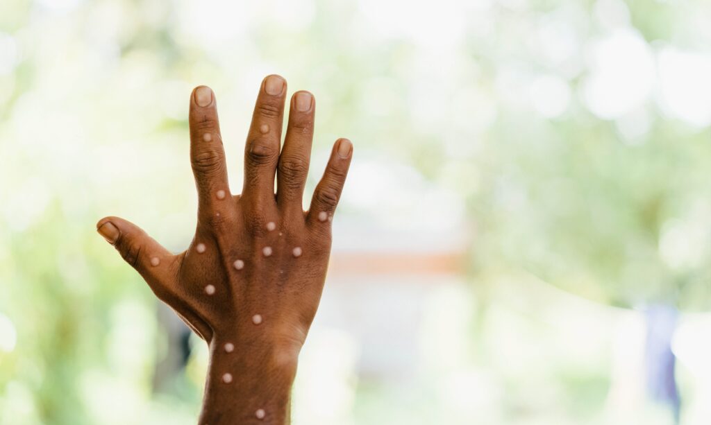 Featured image for “AHF Urges Vaccine Equity as Mpox Cases Surge in Sierra Leone”
